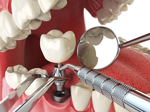 Best Dental Abscess Treatment in Bonne Terre, MO